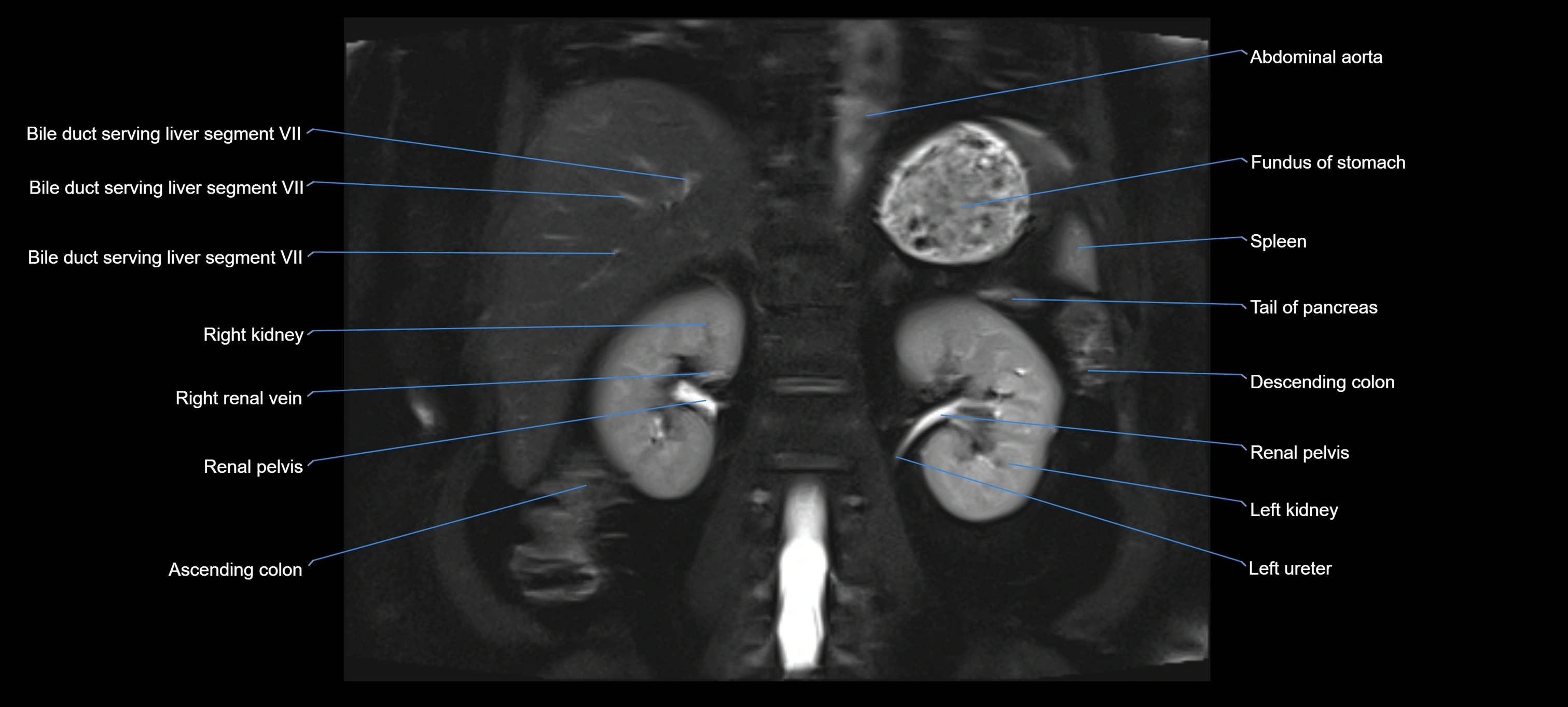MRI MRCP coronal cross sectional 3T radiology  image-img-00001-00019.webp